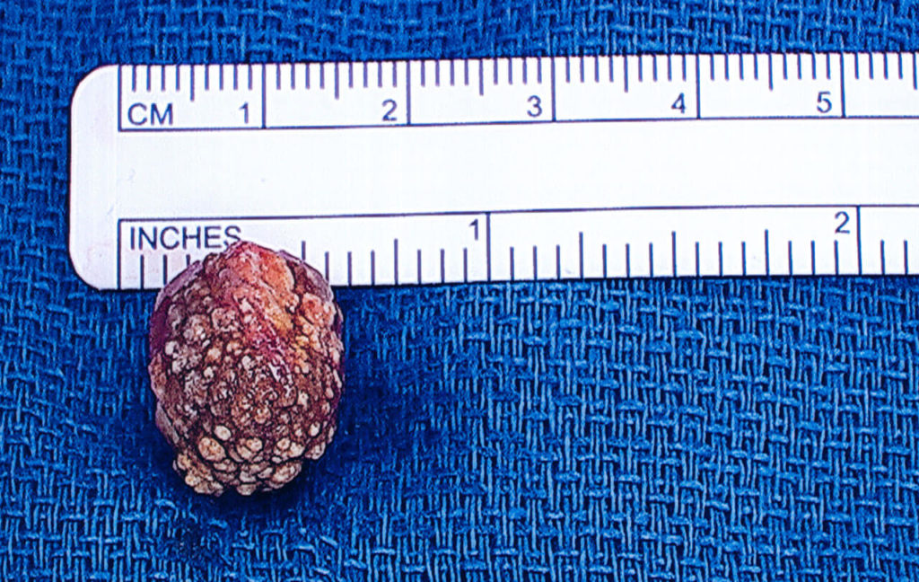 1.5cm gall stone